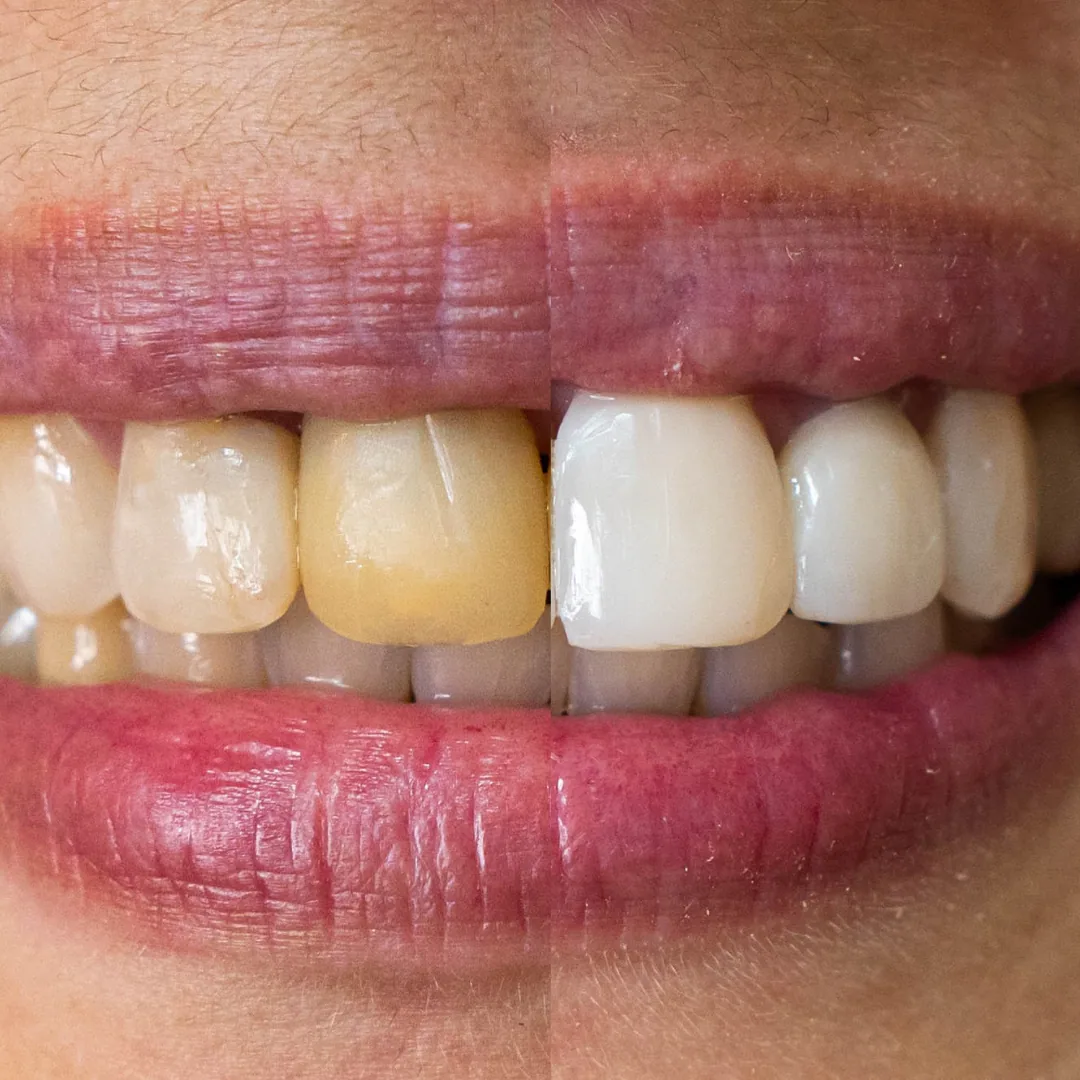 Comparação de sorriso antes e depois — caso 1