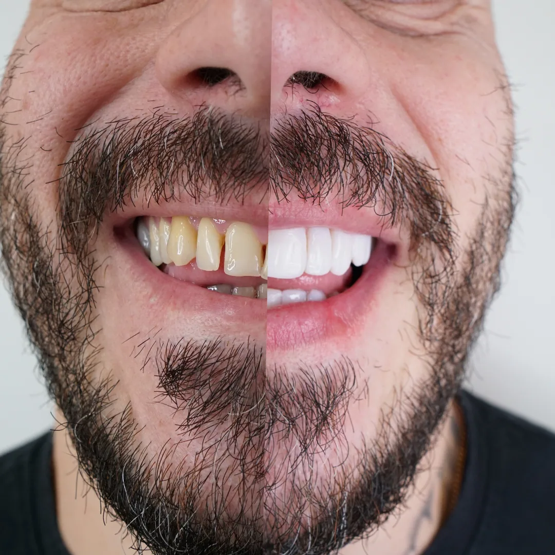 Comparação de sorriso antes e depois — caso 2