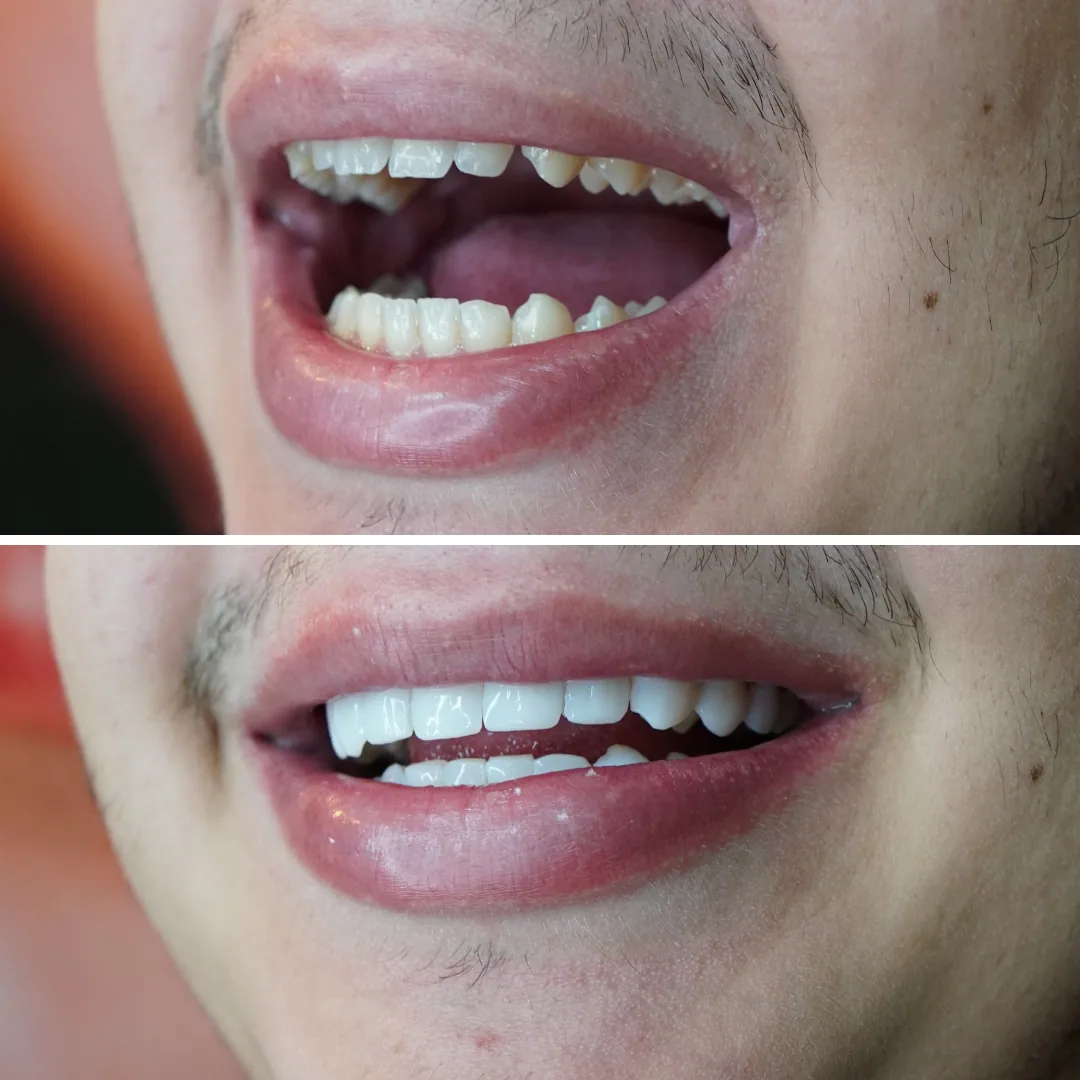 Comparação de sorriso antes e depois — caso 3