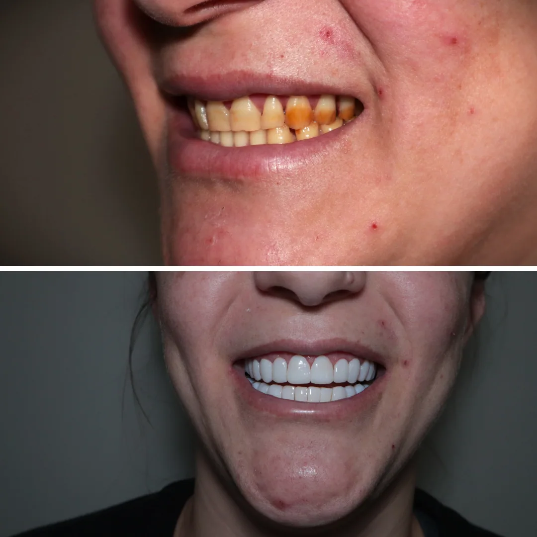 Comparação de sorriso antes e depois — caso 4